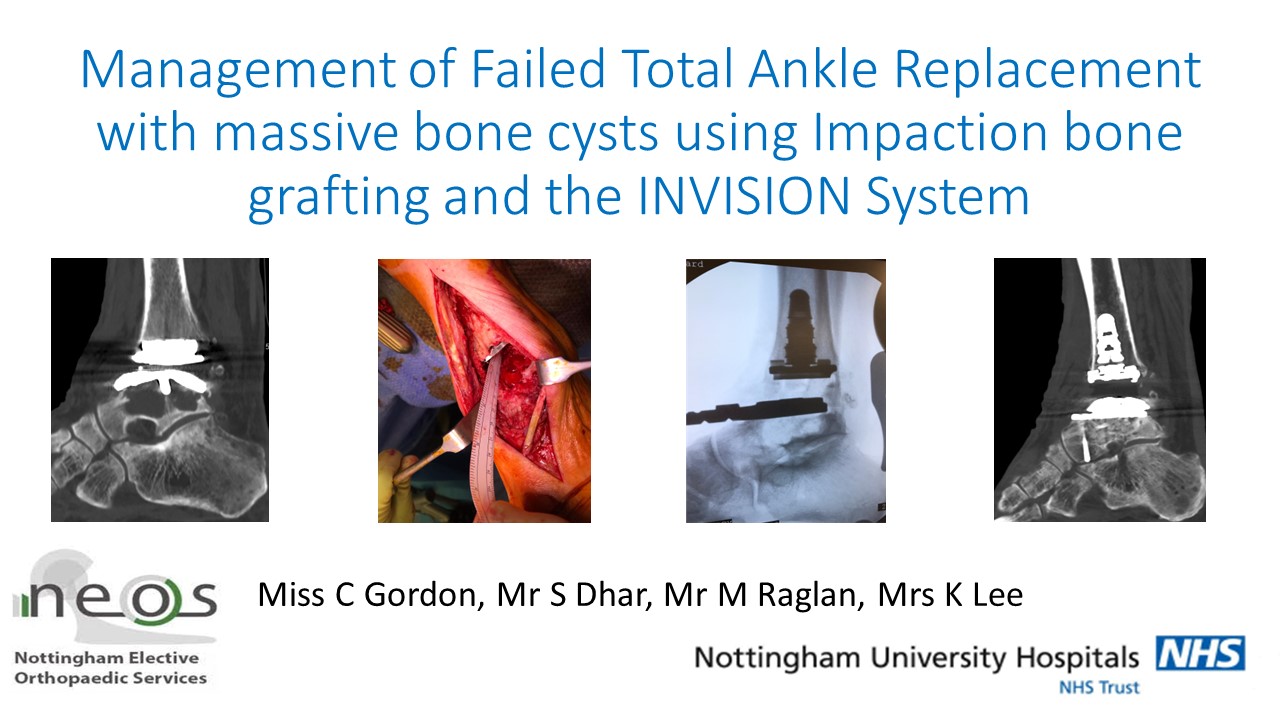 Management Of Failed Total Ankle Replacement And Massive Bone Cysts Using Impaction Bone