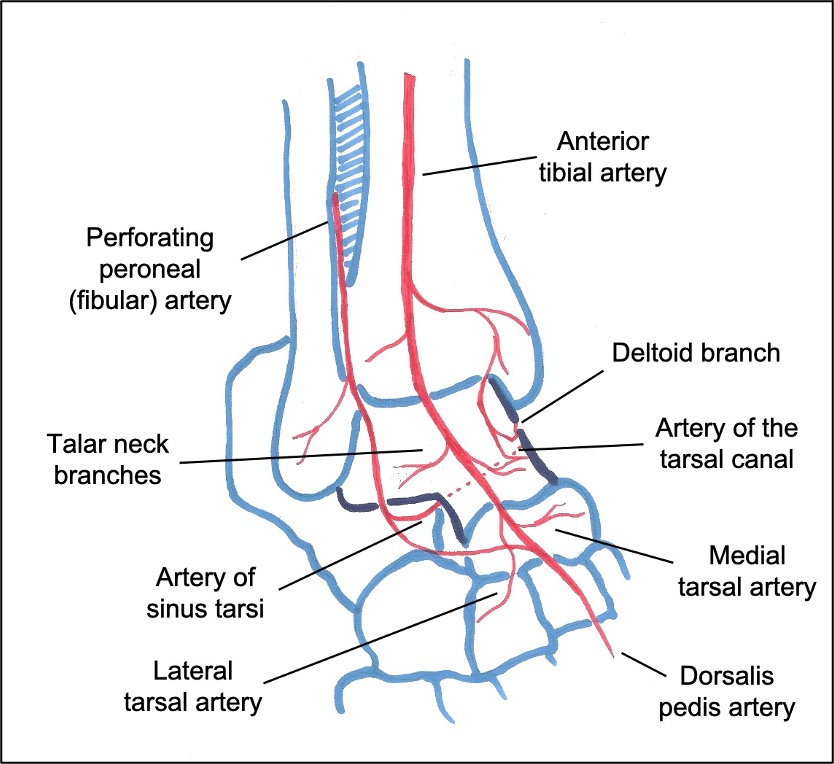 Avascular necrosis