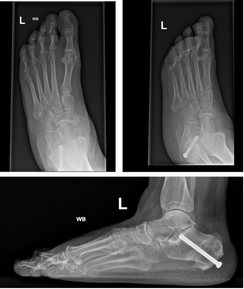 BOFAS > Hyperbook > Midfoot & Hindfoot Disorders > Pes Planus