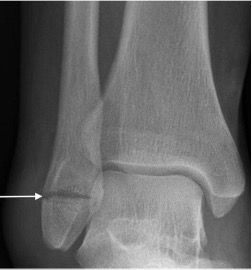 BOFAS > Hyperbook > Radiology > 5. Fractures